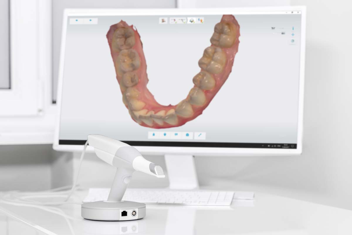 3D scanner with a computer screen showing a digital impression of teeth