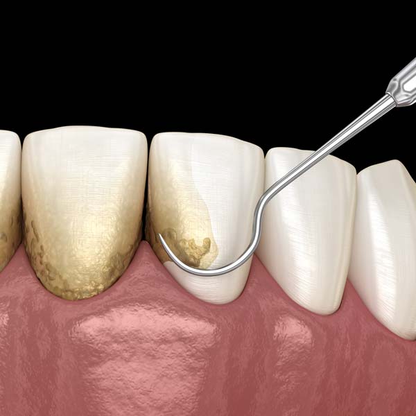 An illustration of plaque being removed from the teeth