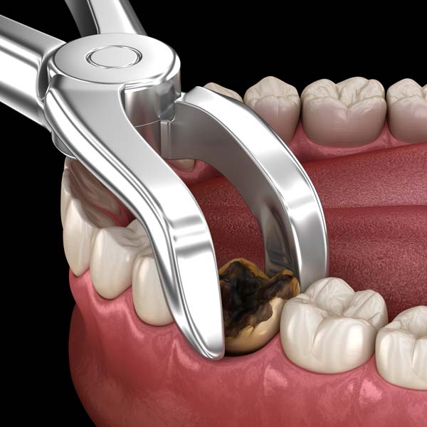 An illustration of a damaged tooth being extracted