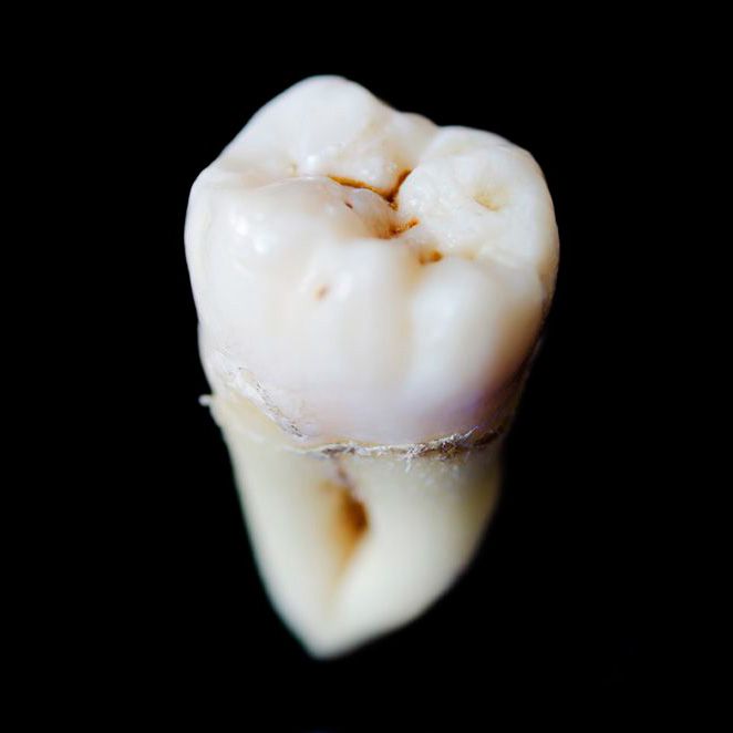 An extracted wisdom tooth
